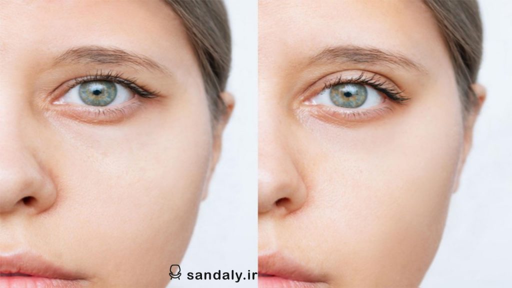 scars-remain-in-eyelid-surgery